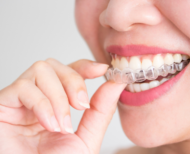 Close-up of a person placing a clear Invisalign aligner on their teeth